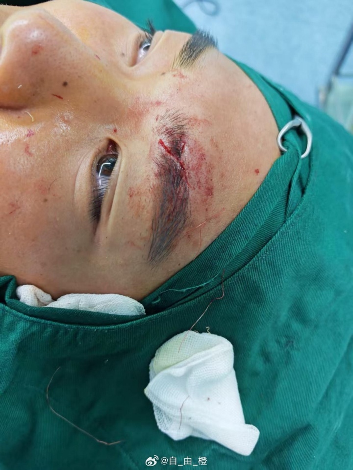 [体育报道]10分钟遭两连击！泰山小将彭逸翔晒伤口：压根不是踢球；吃了一肘(图2)