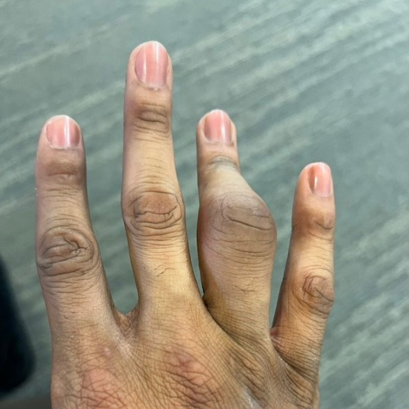 科林斯此前受到手指伤势困扰 近日在德鲁联赛他的手指仍未消肿
