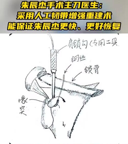 主刀医生：朱辰杰手术很成功 高强度人工韧带可承受200公斤冲撞力