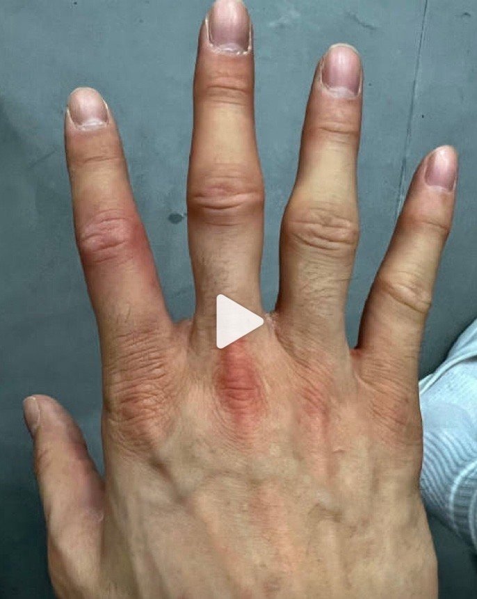 媒体人：郭艾伦10根手指的关节处都有肿胀 留在北京进行治疗