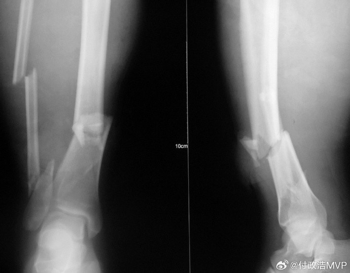 付政浩：右腓骨下段骨折需要钢板固定 陈林坚或需2-3个月恢复