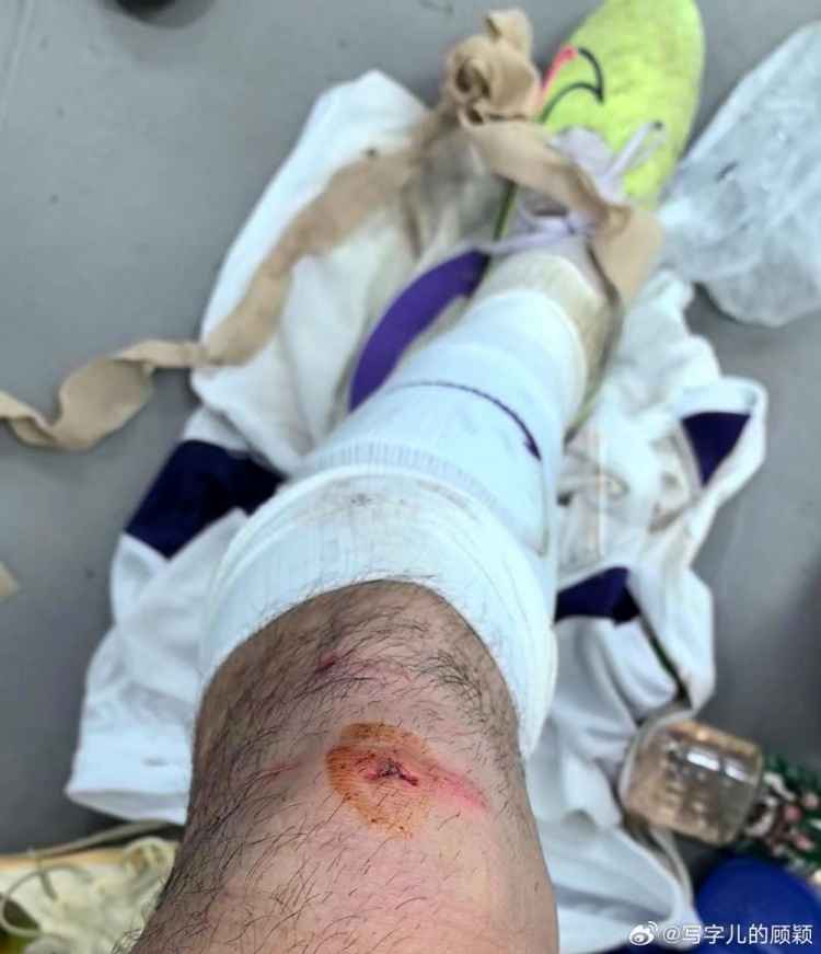 记者：杨梓豪膝盖被踢出伤口，菲奥里奇也是硬伤范畴