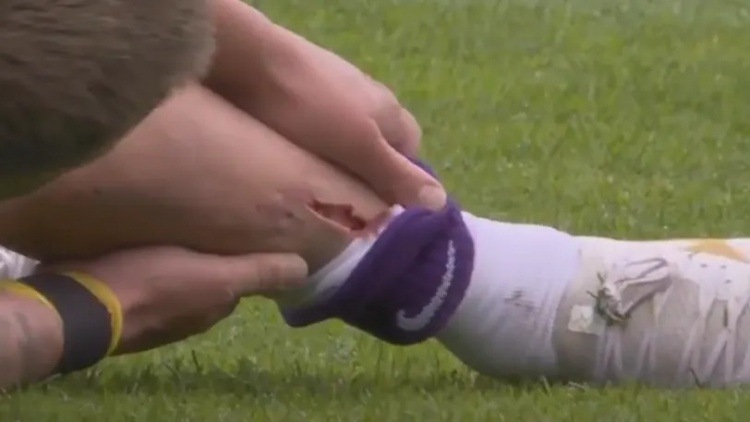 【精彩资讯】慎入！前德甲球员霍尔特比荷甲遭遇凶狠犯规，脚被划开一道口子(图2)