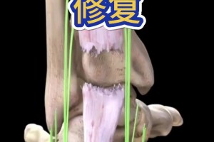 看着都疼啊！科普帖：球员脚跟腱断裂是如何进行修复的？