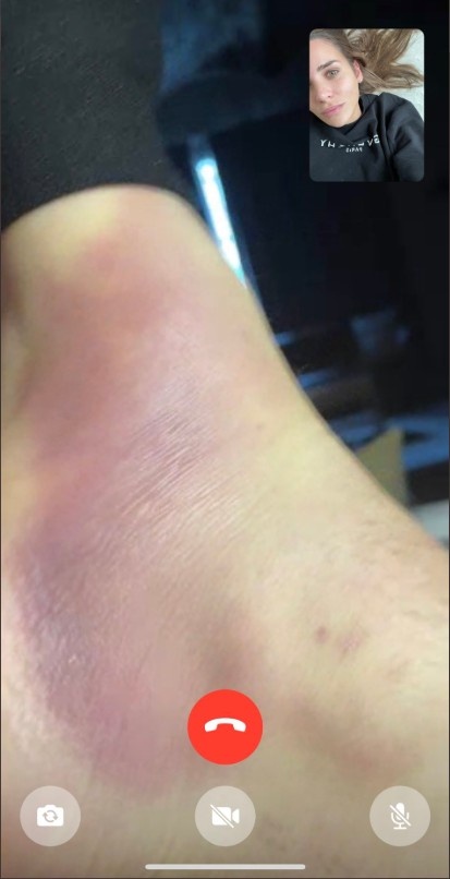 巴尔韦德女友晒其脚踝受伤图,大面积红肿伤情严重