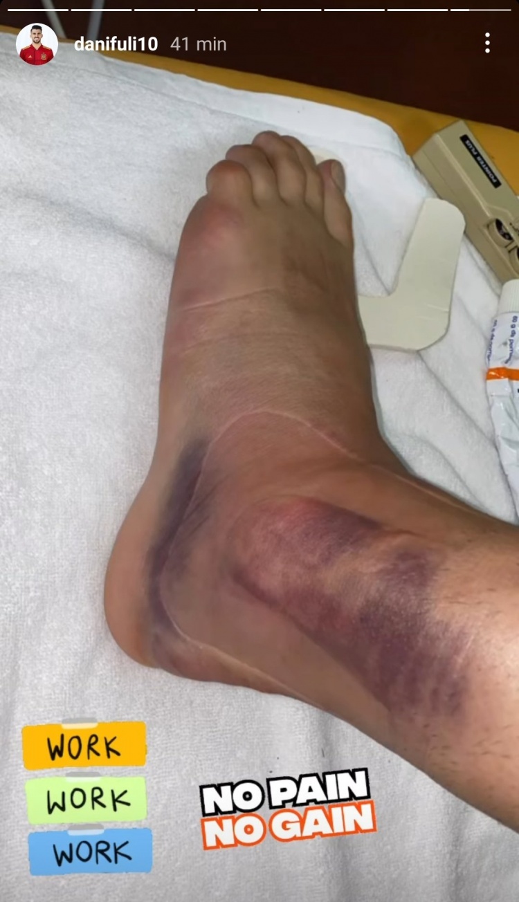 塞巴略斯晒脚踝伤势图，仍可见肿胀和淤青