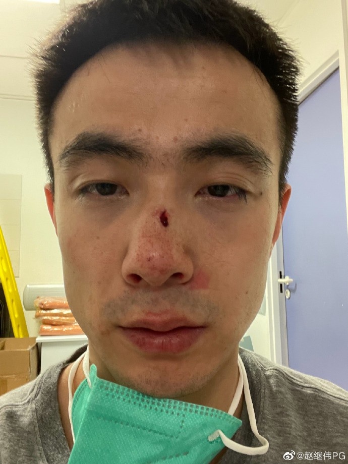 慎点赵继伟晒鼻子受伤照谁还不是个精神小伙了