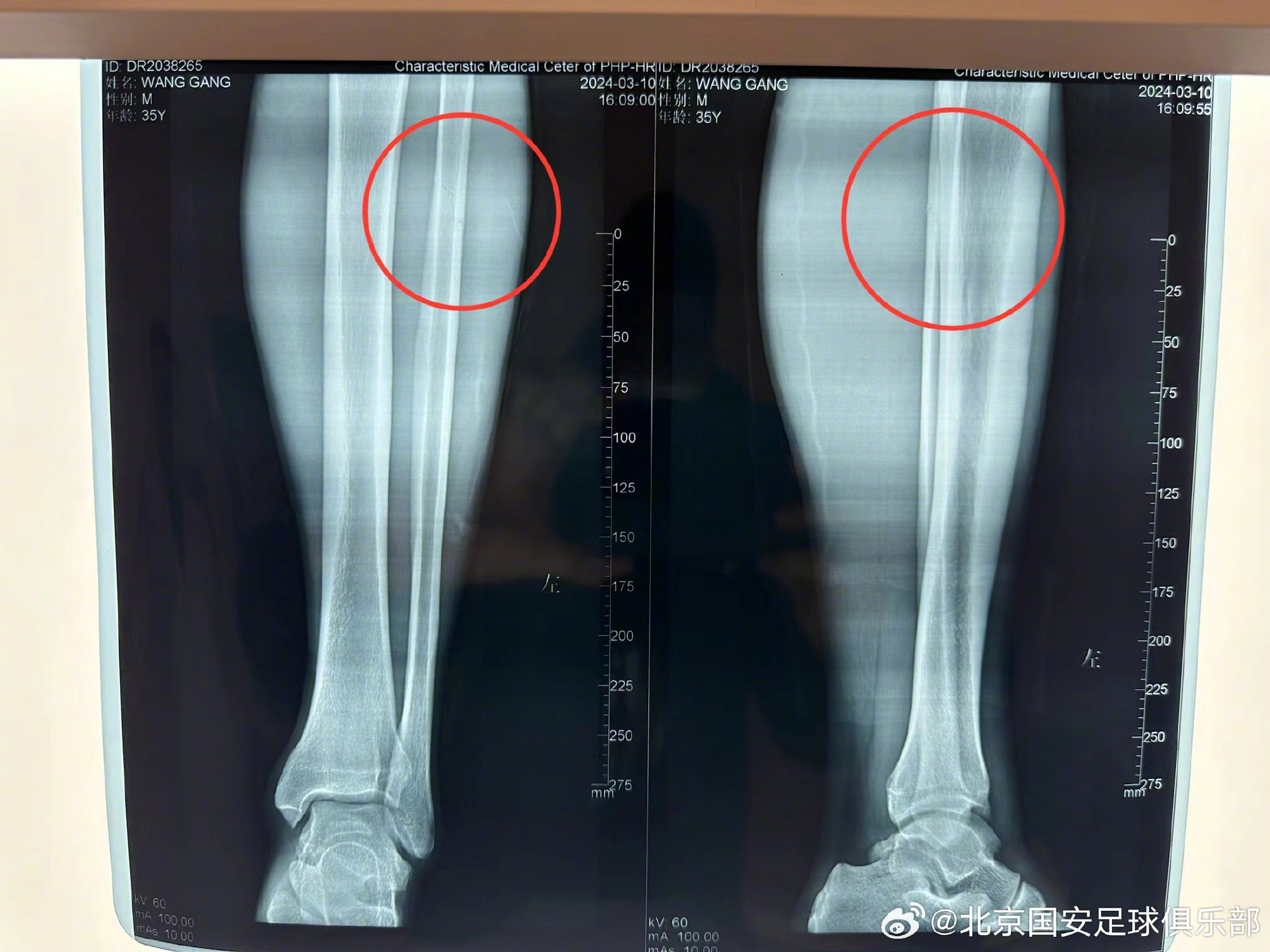 伤情报告：王刚左小腿中上段腓骨裂纹骨折
