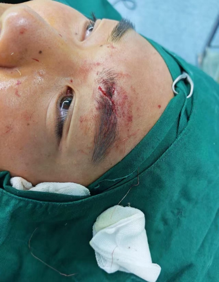 [值得一看]10分钟遭两连击！泰山小将彭逸翔晒伤口：压根不是踢球；吃了一肘(图2)