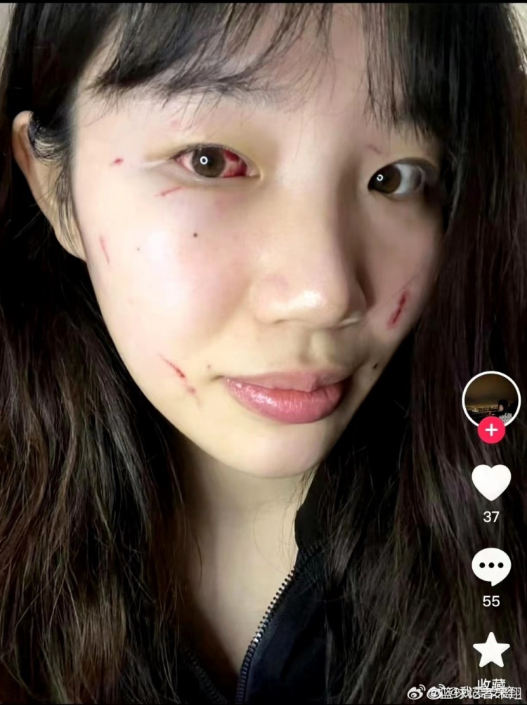 北京女篮中锋刘晶赛后眼部结膜出血鼻骨骨折并且面部有多处抓伤