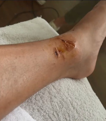 看着都觉得疼！李帅晒伤口照：艰苦的客场挺不容易