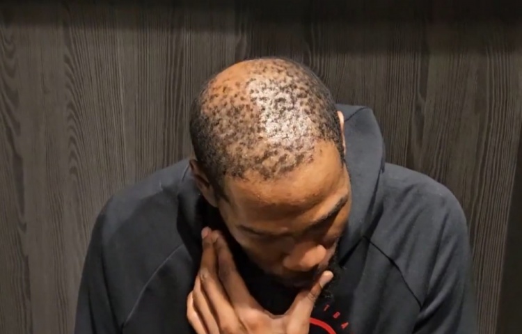 [杜兰特]37岁还单身有原因！杜兰特秃顶这么严重 这发量找对