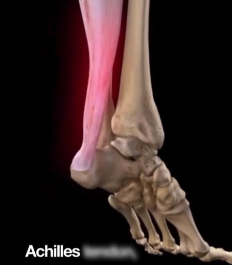 【赛前必读】10个月康复已算快！跟腱撕裂为什么✨是竞技体育的“阿喀琉斯之踵”(图2)