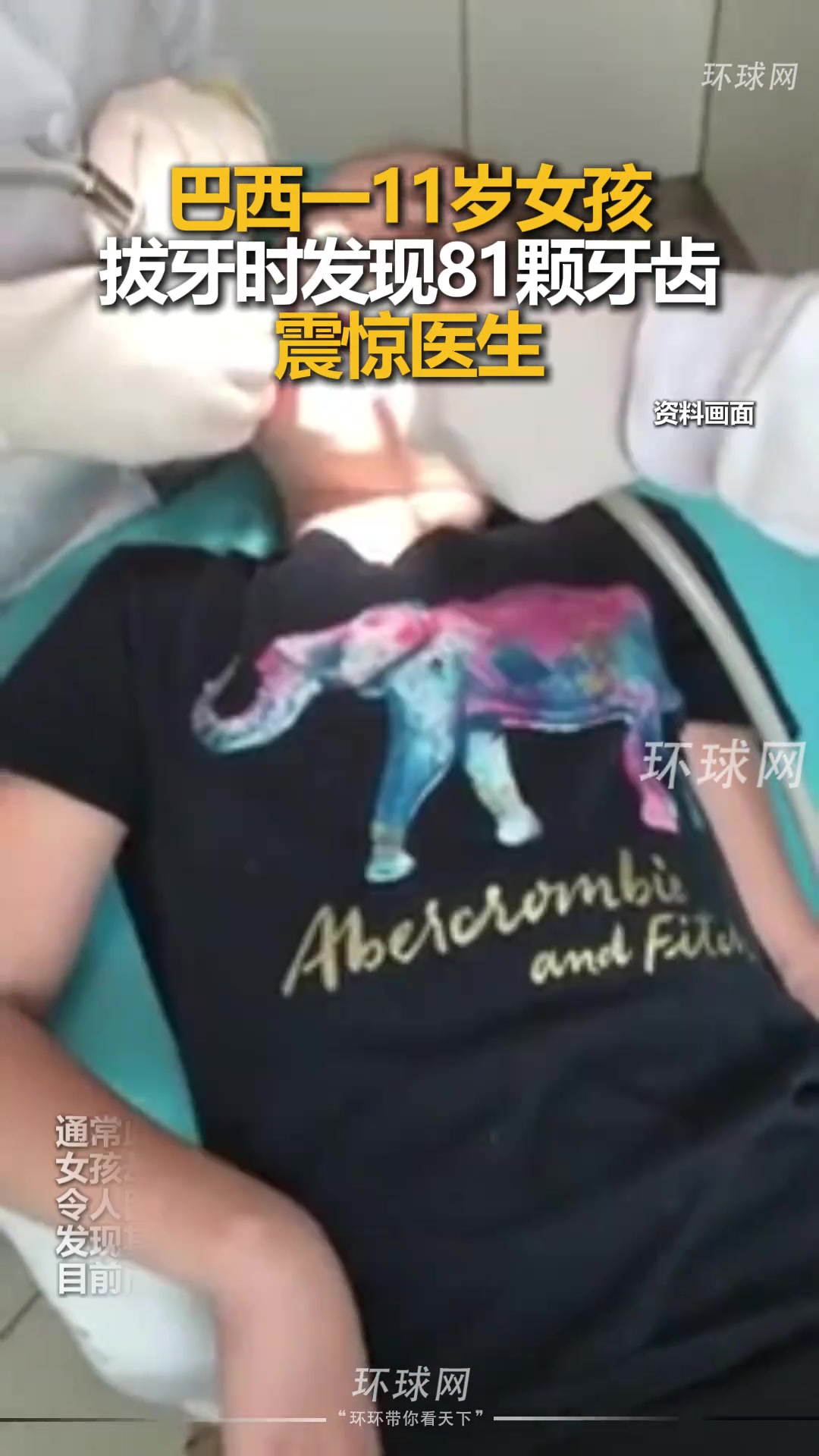 巴西一11岁女孩拔牙时发现81颗牙齿，震惊医生
