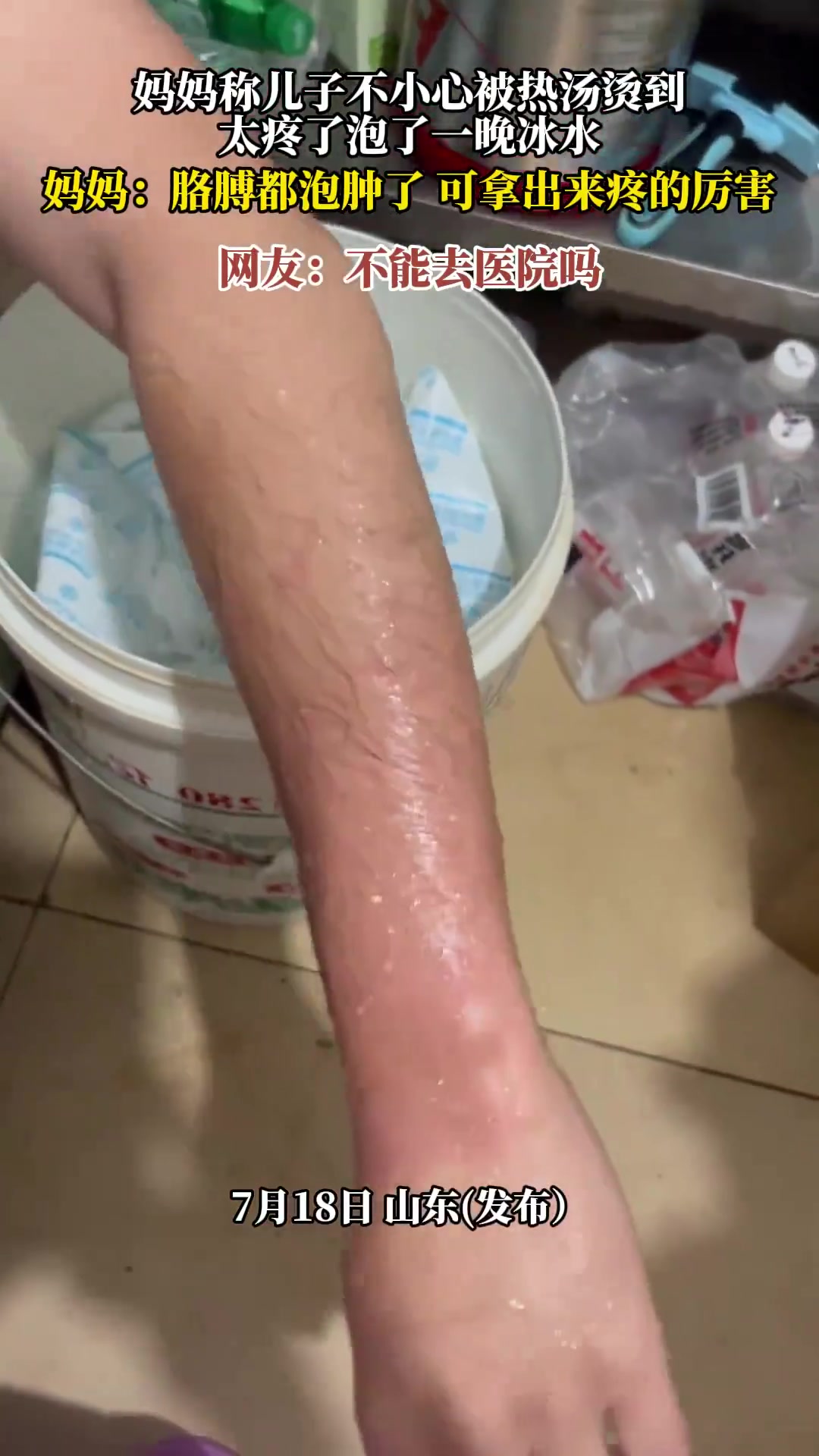 妈妈称儿子不小心被热汤烫到，太疼了泡了一晚冰水