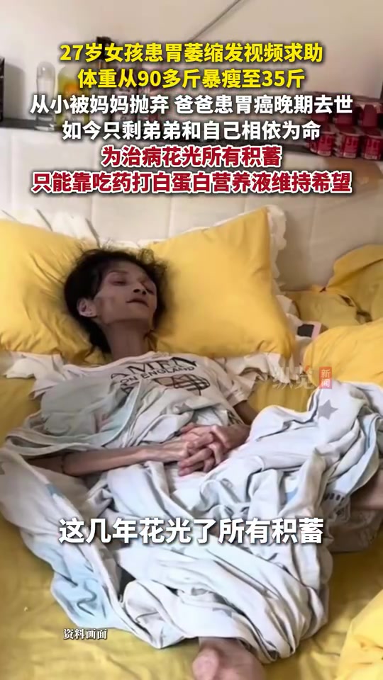 27岁女孩患胃萎缩体重从90多斤暴瘦至35斤！！