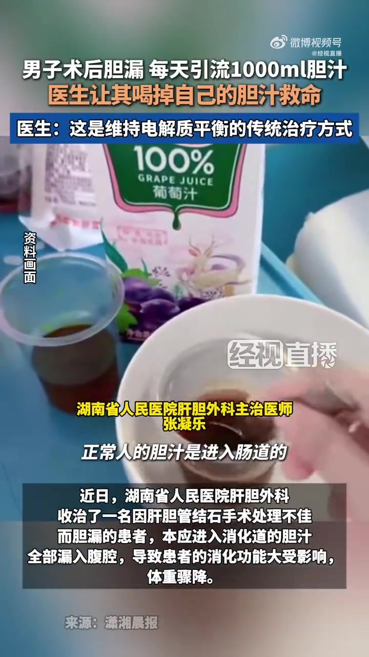 湖南患者胆漏喝自身胆汁助消化