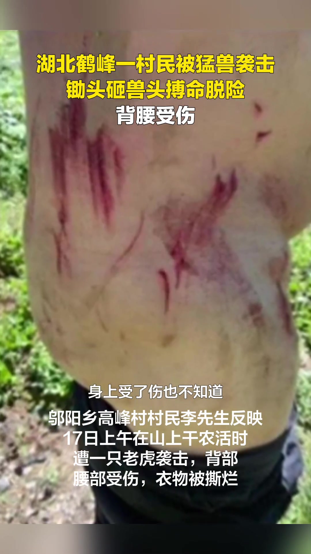 村民被猛兽袭击，锄头砸兽头搏命脱险背腰受伤