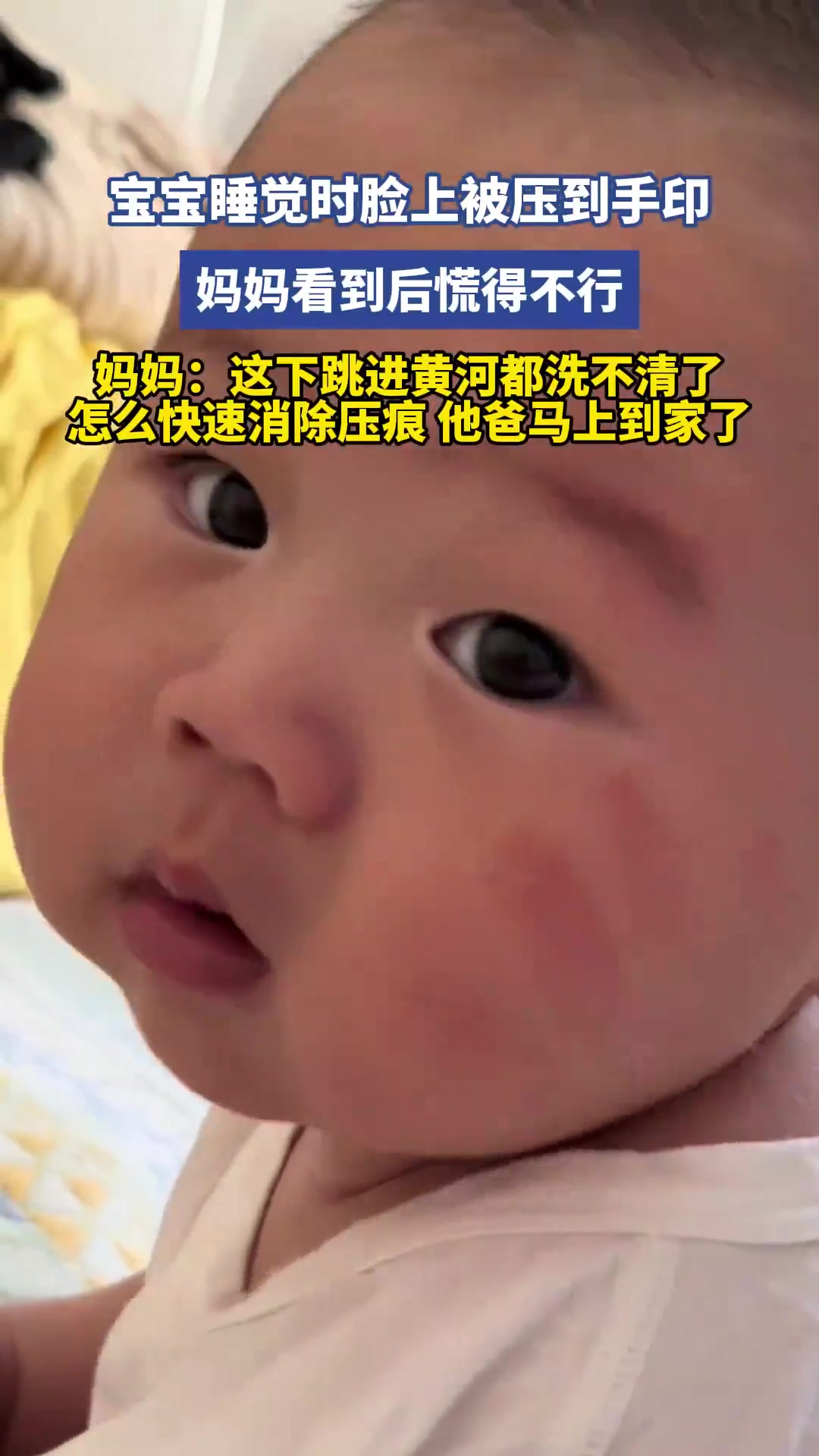 宝宝睡觉时脸上被压到手印，妈妈看到后慌得不行
