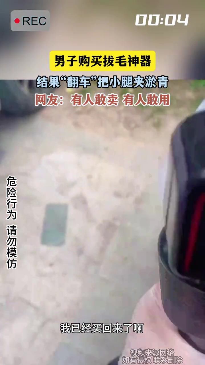 男子购买拔毛神器,结果“翻车”把小腿夹淤青